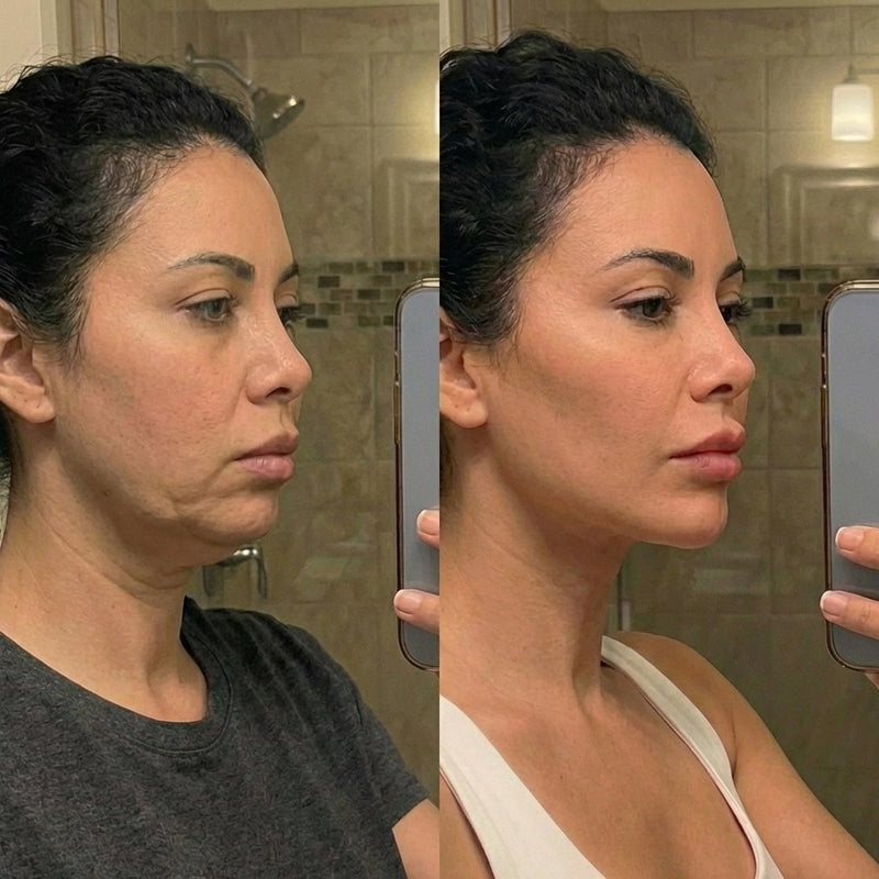 Résultat avant et après — Mieux que le Botox